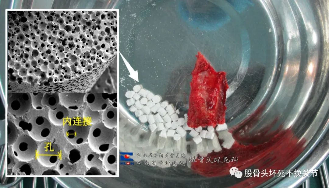 植骨锻炼双侧塌陷股骨头已撑过7年