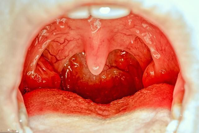 急性咽炎真实图片图片
