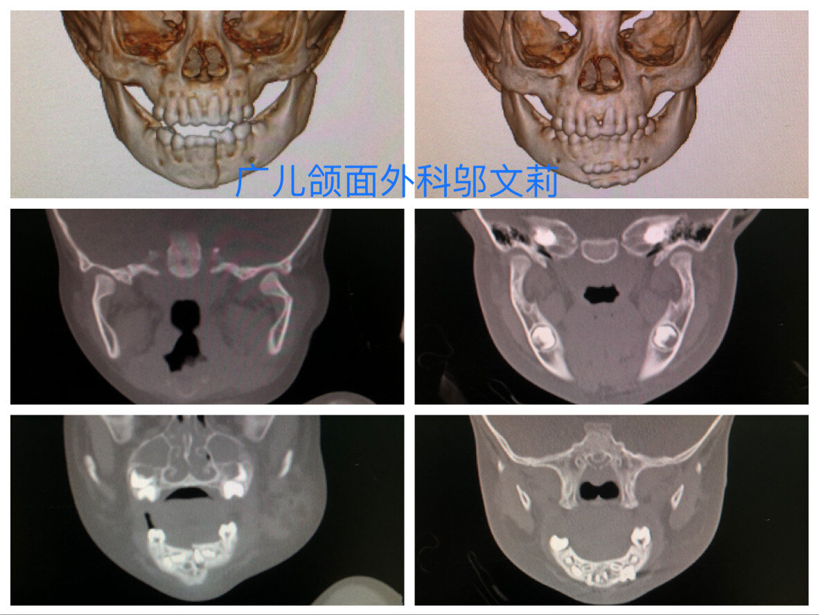 【口腔外科联合正畸治疗】儿童下颌骨骨体及髁状突骨折