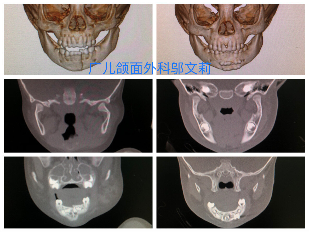 口腔外科聯合正畸治療兒童下頜骨骨體及髁狀突骨折