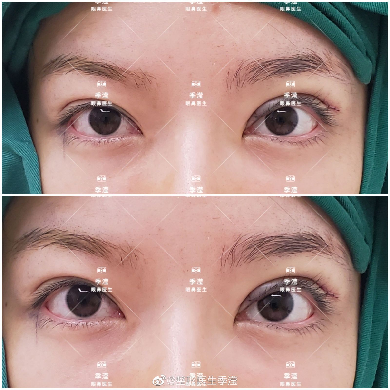 除了清冷颜扇型双眼皮还有翘翘板一样的提肌