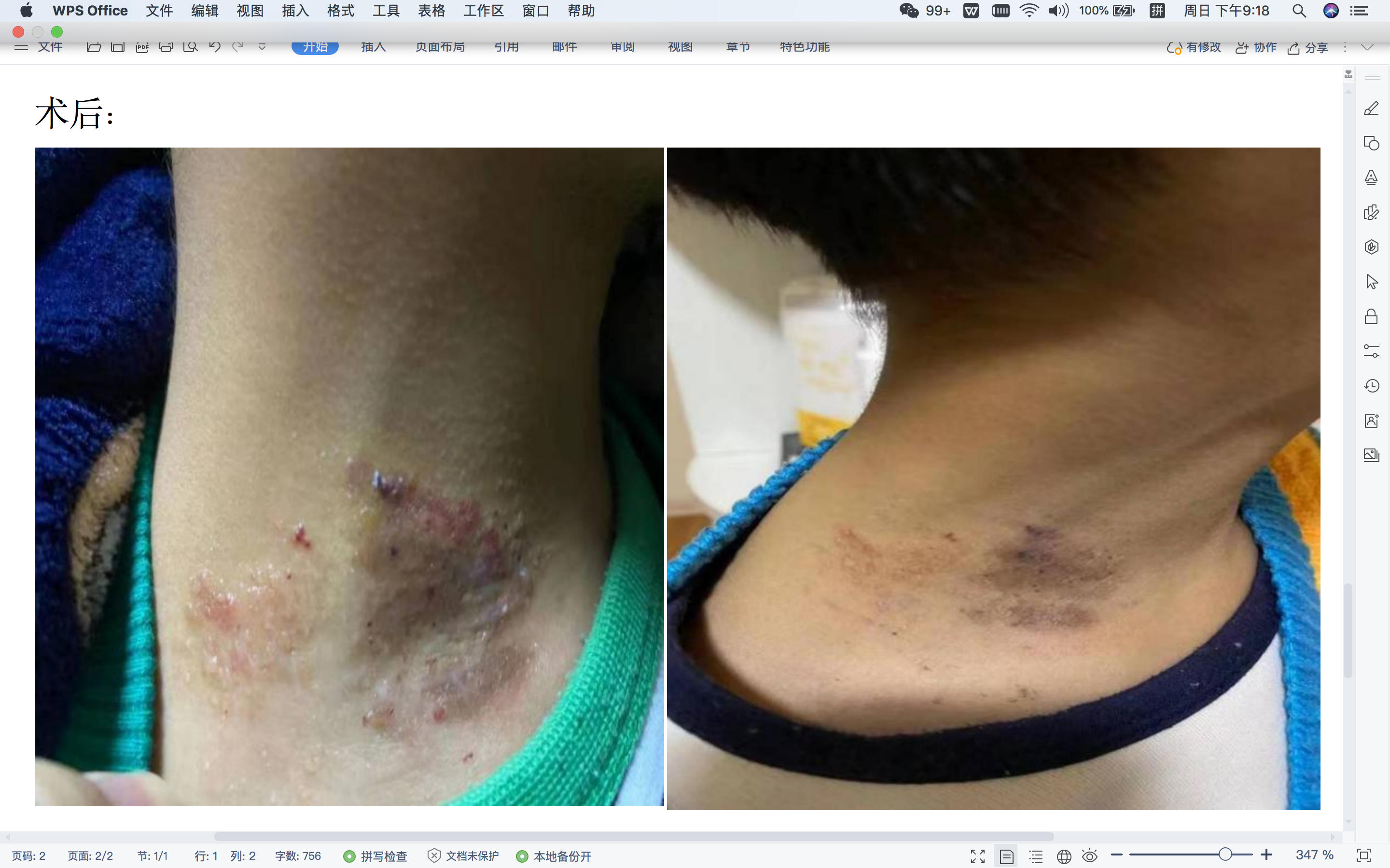 皮肤淋巴管畸形治疗病例_淋巴管瘤_淋巴管瘤治疗方式 - 好大夫在线