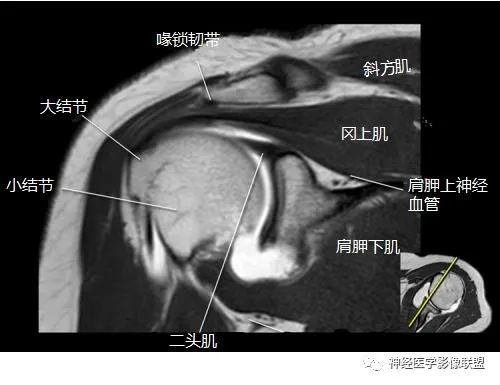 盂肱韧带mri解剖图片