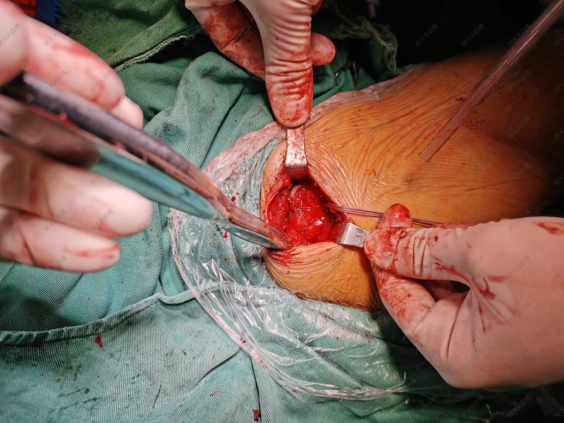 小切口肩袖缝合_肩关节损伤 - 好大夫在线