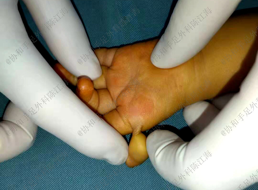拇指发育不良漂浮拇要尽早手术,这个时间点把握好,手术更有优势_先天