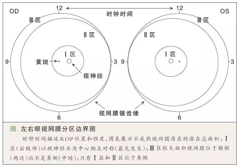 早产儿视网膜病变筛查指南 