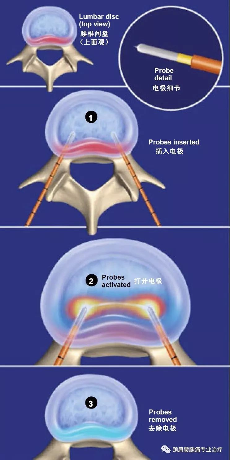 双极射频椎间盘修复术 - 好大夫在线