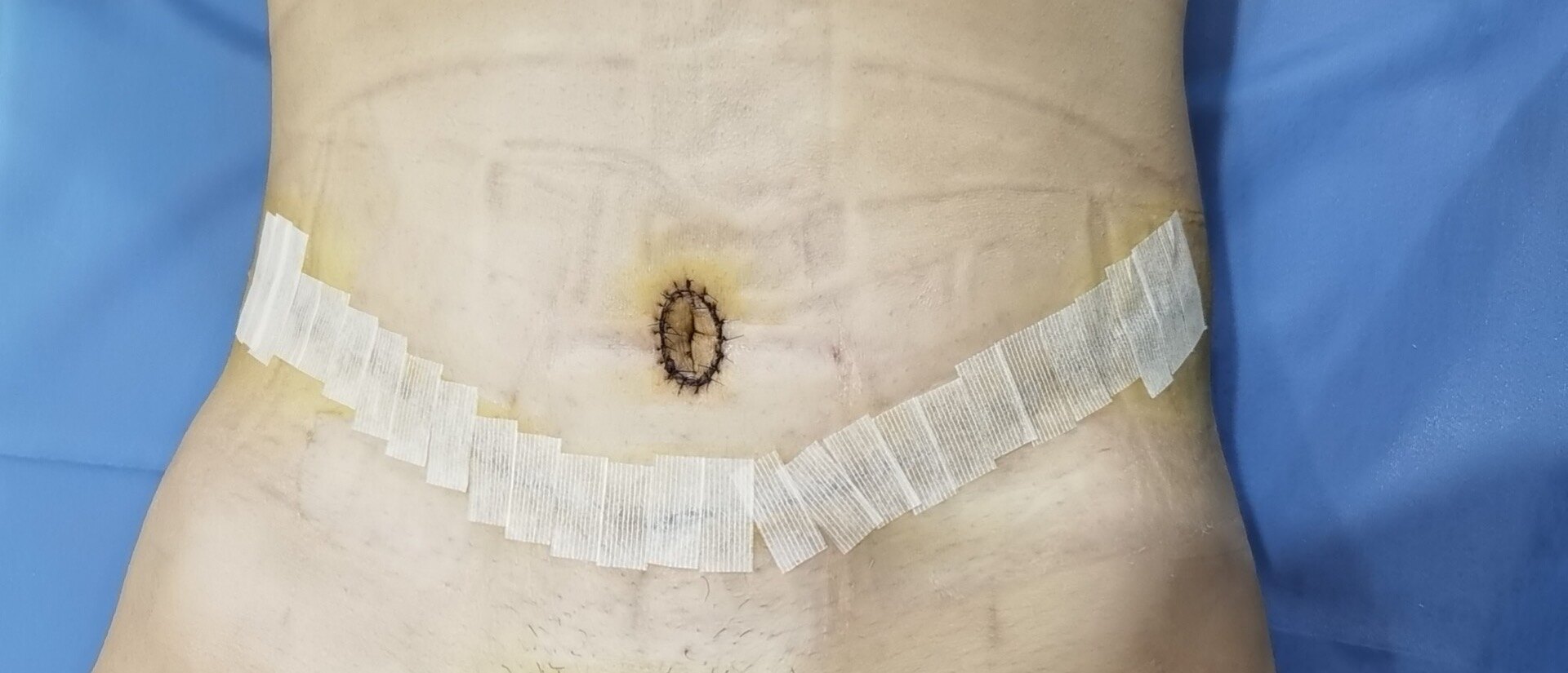 刘春军医生原创 腹壁整形手术后须知及术后护理精要 腹壁整形 好大夫在线 刘春军医生原创 腹壁整形手术后须知及术后护理精要 腹壁整形 好大夫在线