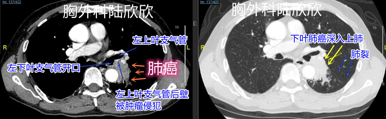 肿瘤纵隔窗肺窗2张图水印.jpg