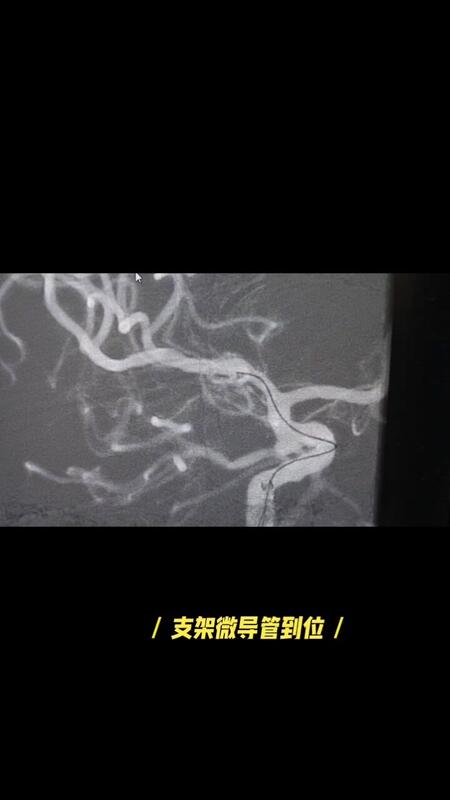 三十七分钟动脉瘤栓塞术！