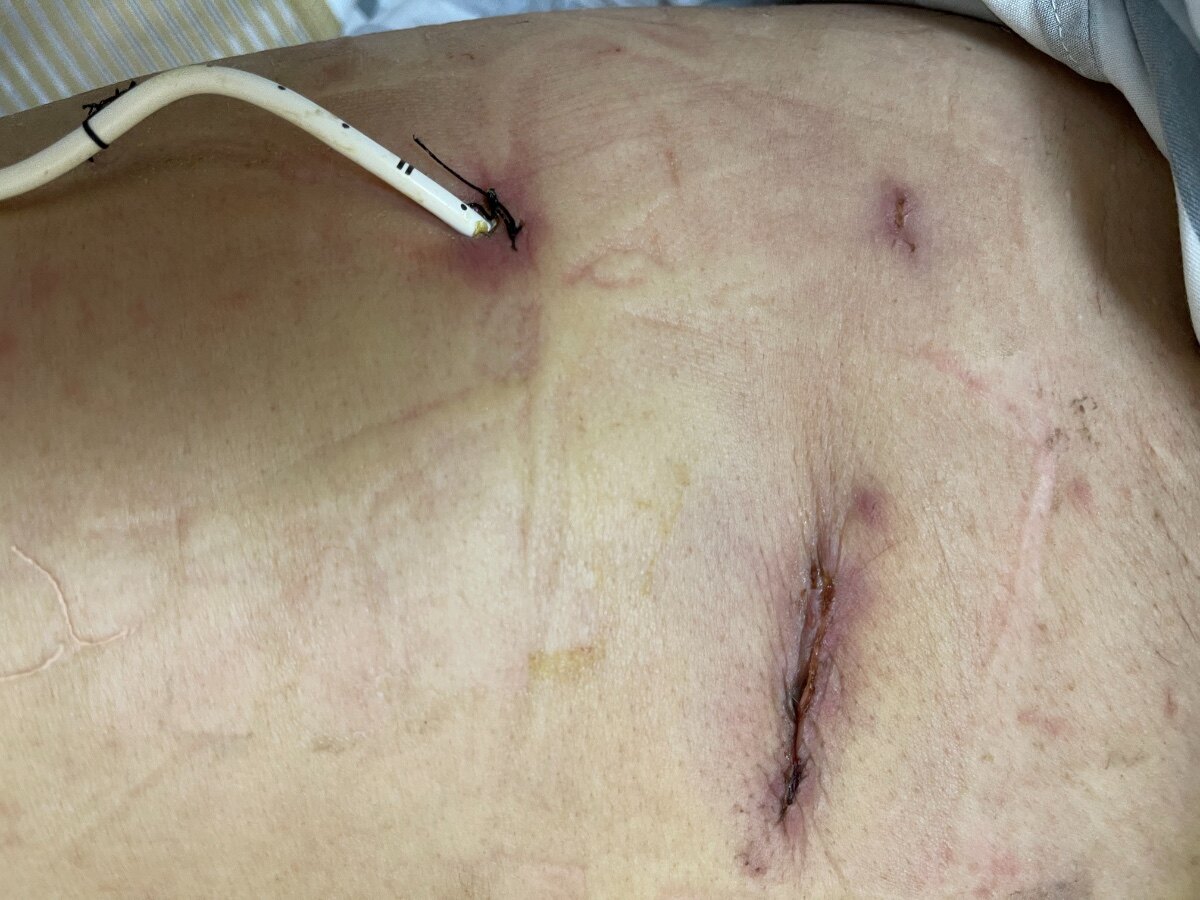 肺结节术后疤痕图图片