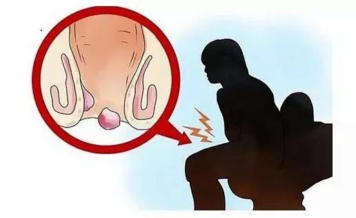 痔疮有什么危害