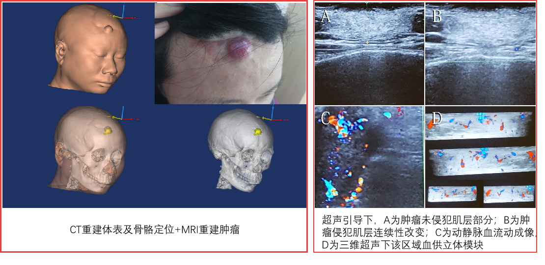 隆突性皮纤维肉瘤图片