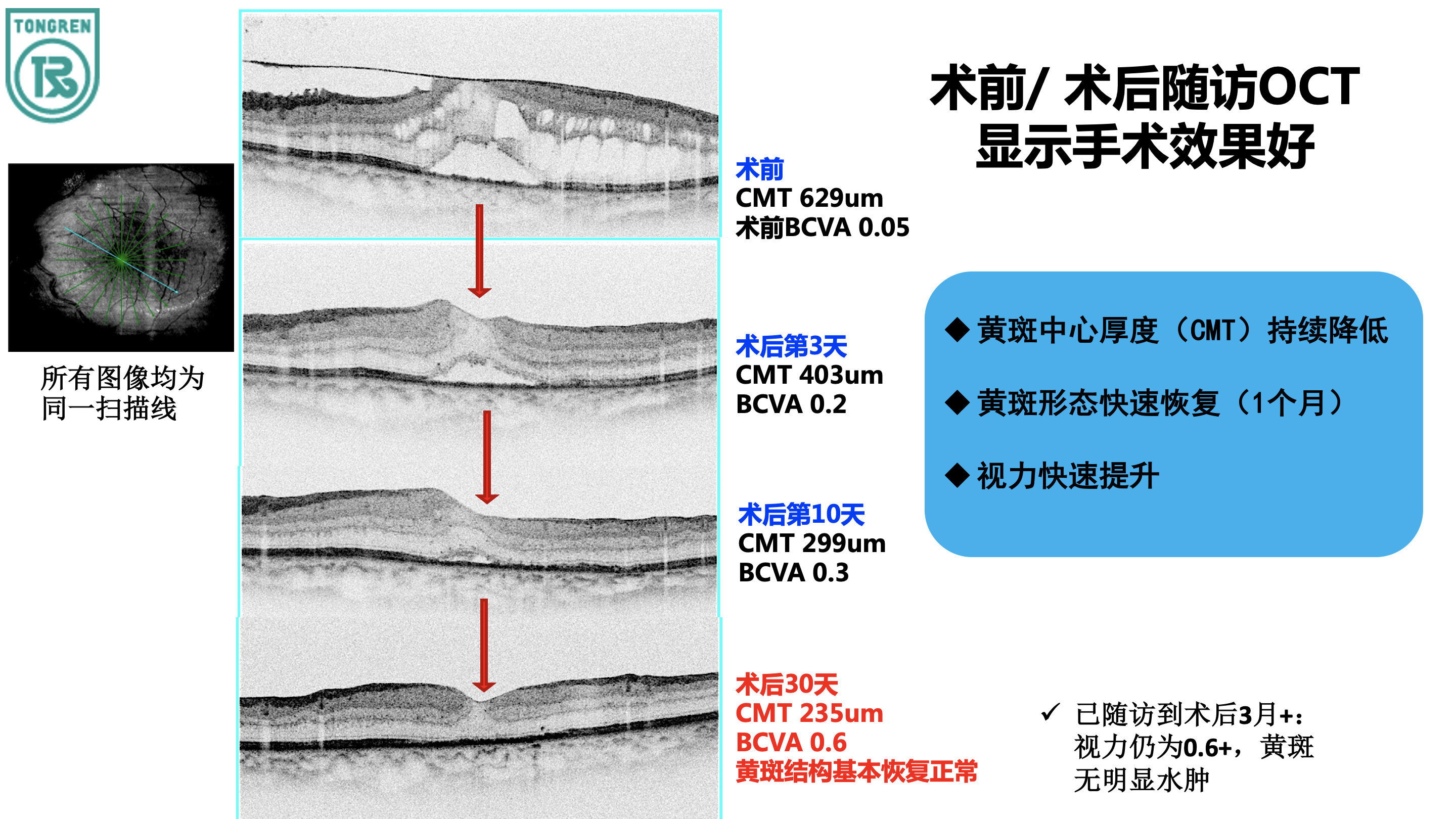 糖尿病ERM手术效果.jpg