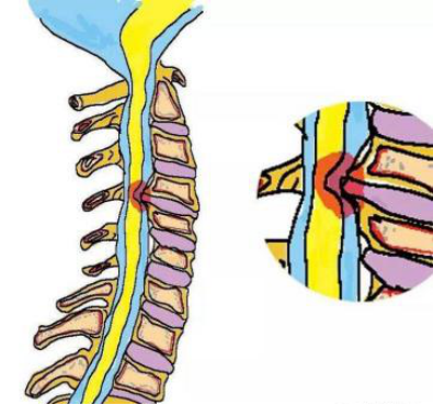 脊髓型颈椎病(最恐怖):起病缓慢,但致残率高高发年龄段为40~60岁