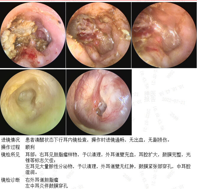 耳朵里面的胆脂瘤图片图片