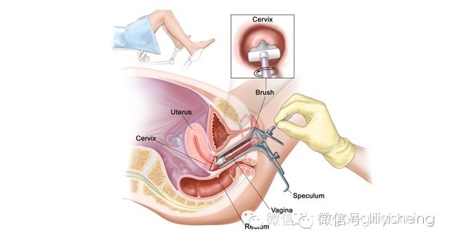 自己检查宫颈的方法图片