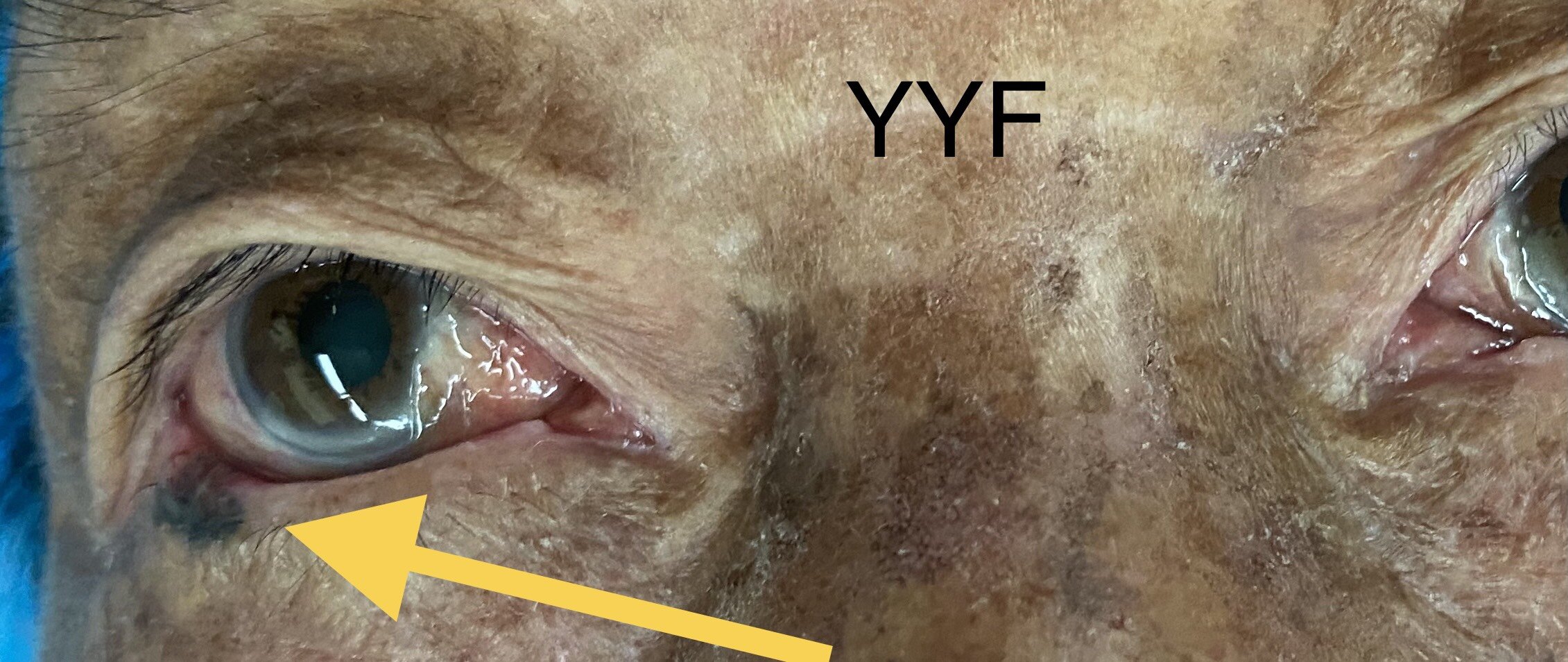 眼睑肿瘤之下眼睑外侧1/2 & 基底细胞癌的切除和重建