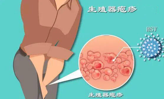女性生殖疱疹发作症状图片