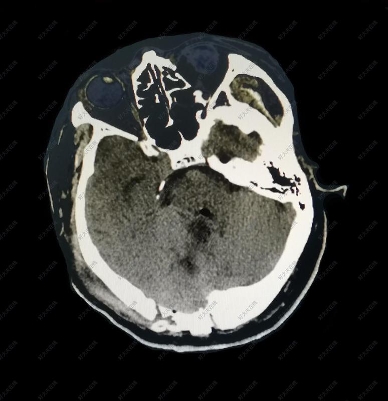 右小脑转移癌_脑转移瘤 - 好大夫在线