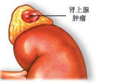 腎上腺腫瘤_介紹_症狀表現_治療方式 - 好大夫在線