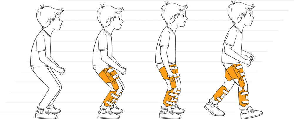 膝痛会影响关节负重能力,膝关节活动度和股四头肌功能,此时走路的步态