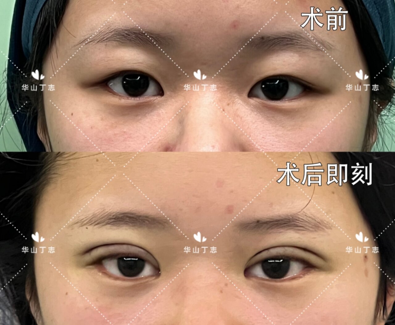 肿眼泡全切双眼皮术后即刻术前分析:重度肿眼泡手术方案:全切双眼皮