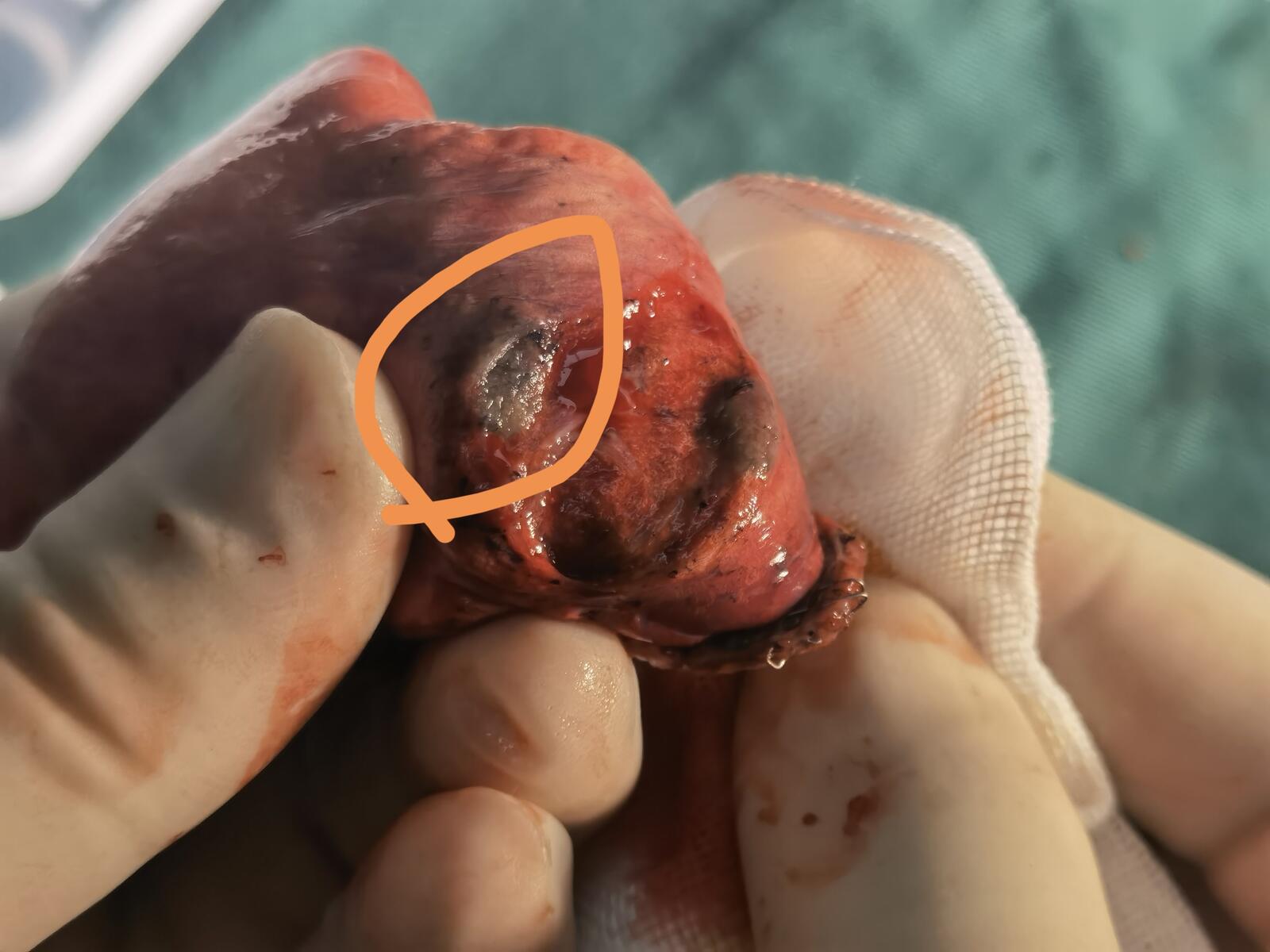 肺磨玻璃结节典型病例分享 患者需要上传什么样的照片 - 好大夫在线