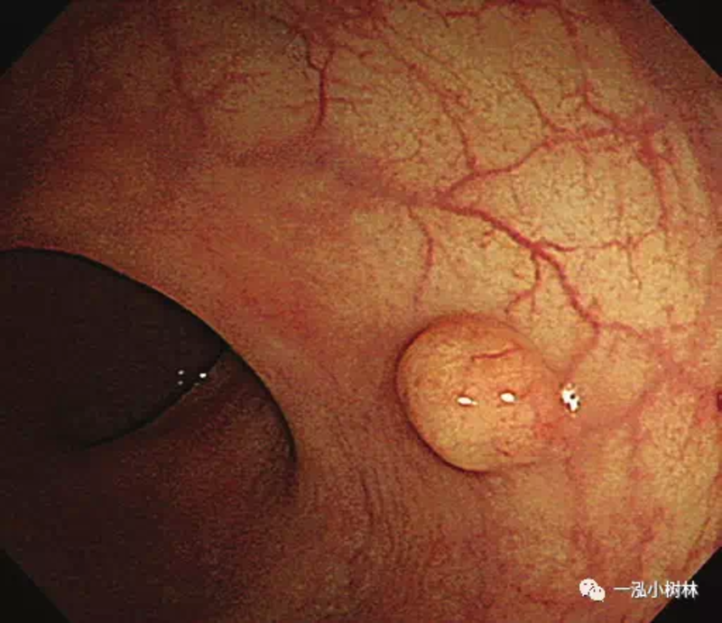肠镜下肠癌图片图片