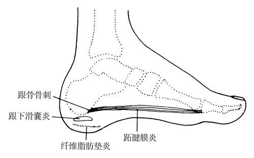 该症的特点是跟骨跖面疼痛,多发生于中年以后的