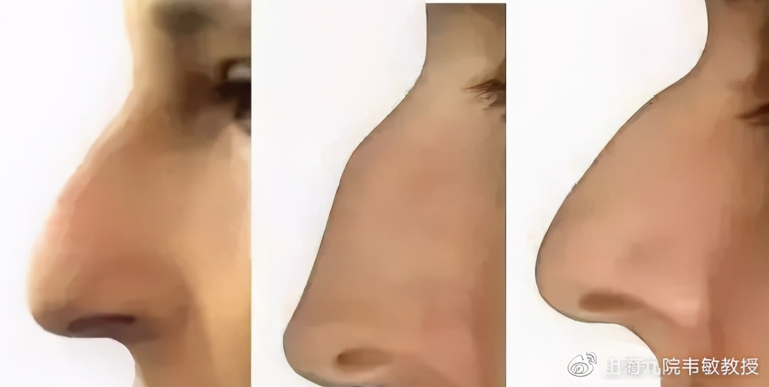影响美观与气质的鹰钩鼻如何矫正 鼻部整形