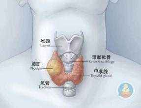 大脖子，可能是甲状腺肿大，对比照片，您有吗？