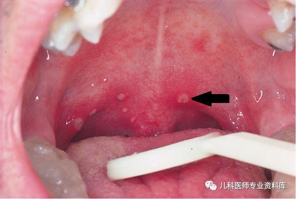 咽峡炎疱疹初期图片图片