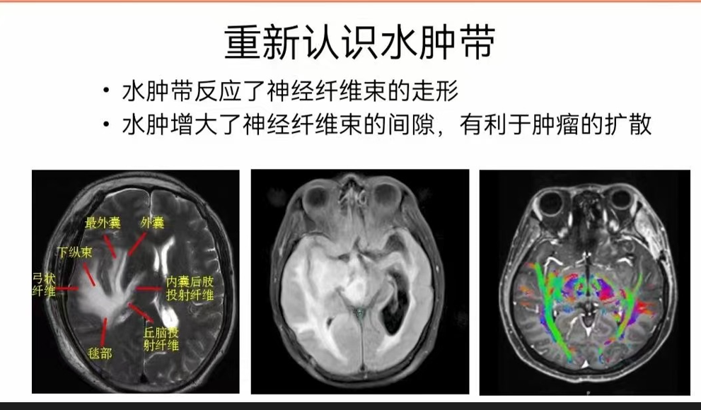 重新认识水肿带.png