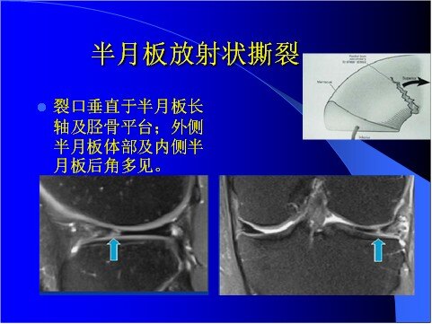 半月板影像图图片