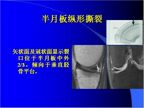 半月板撕裂核磁共振图图片