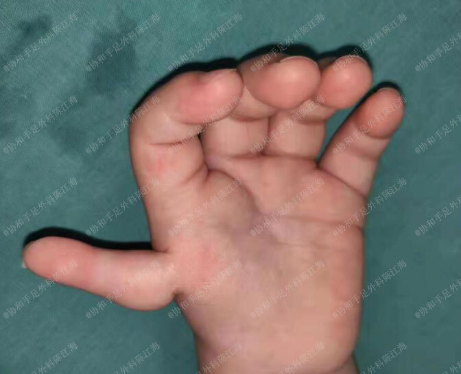 孩子右手多指,左手漂浮拇,双手的手术都很麻烦,但一期术后效果还不错!