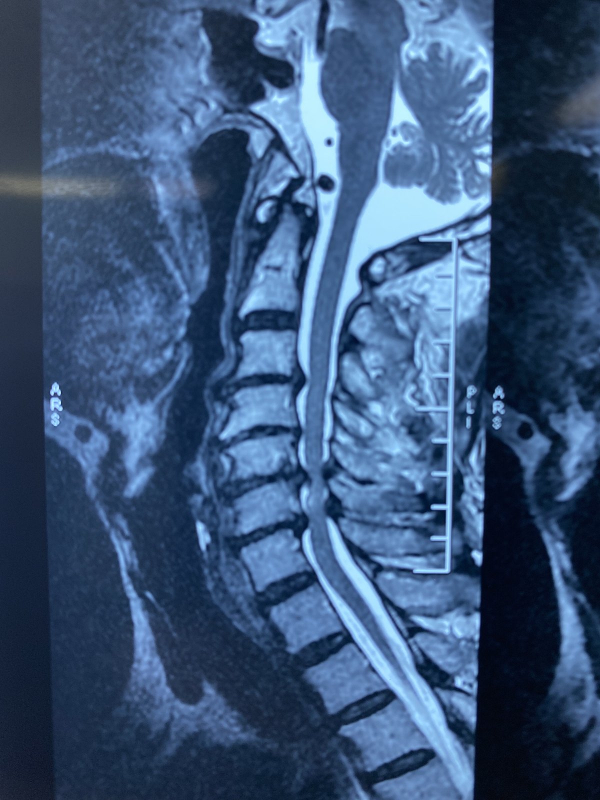 术前ct平扫:后纵韧带骨化,脊髓受压,骨性椎管狭窄术前颈椎ct示:多个节