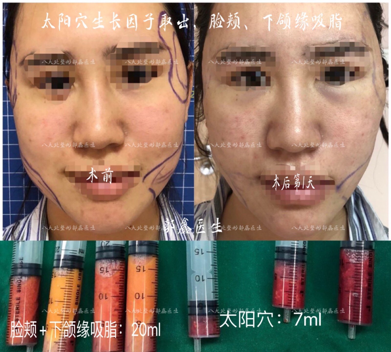 生长因子,童颜针,脂肪填充修复案例和简介(郭鑫医生)_注射美容_治疗