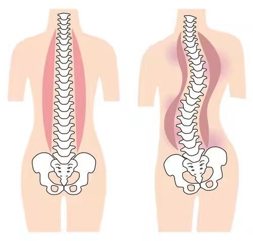 医学科普:什么是成人退变性脊柱侧弯?如何保守治疗呢?