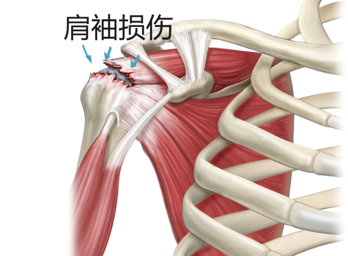 左肩膀疼痛部位图图片