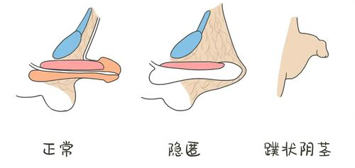 发育不平衡现象,青春期骨骺闭合前应用睾酮补充治疗有效延长阴茎长度