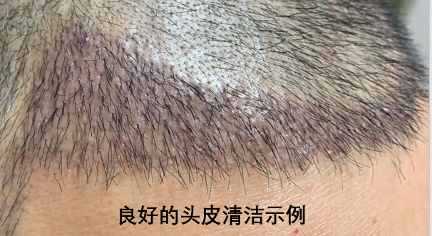 FUT法毛发移植术前术后注意事项_植发_治疗介绍_护理及注意事项 - 好大夫在线