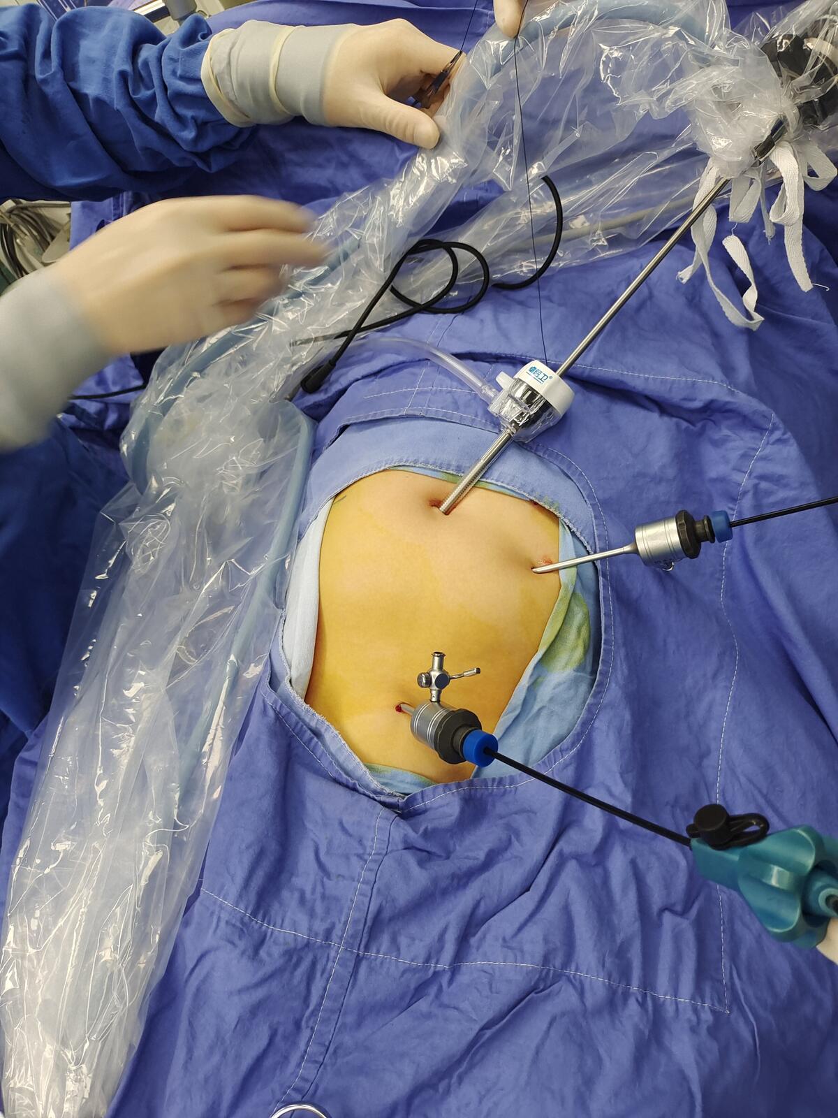 超微创腹腔镜下阑尾切除术 