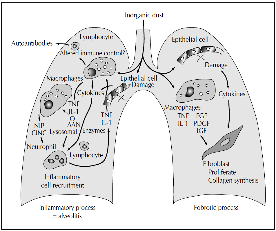 肺间质示意图图片