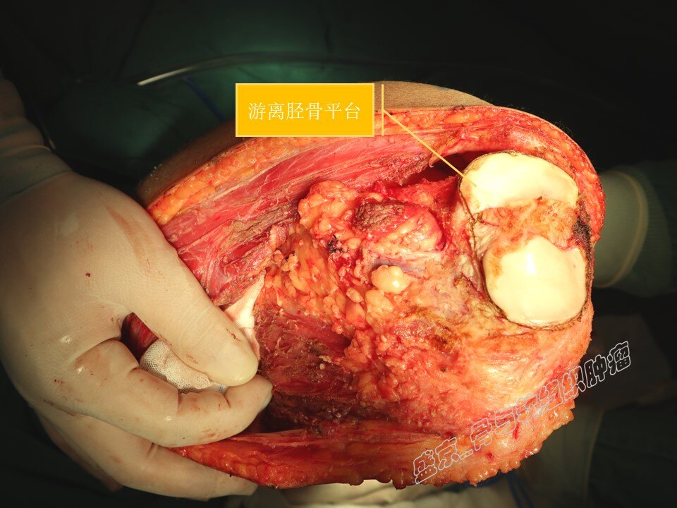 骨肉瘤晚期图片图片