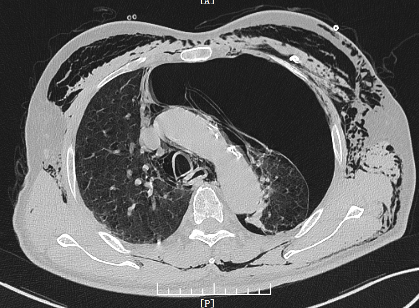 张力性气胸活瓣图片