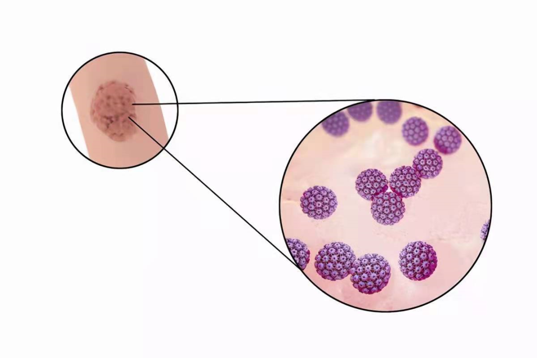 乳头裂开菜花图片