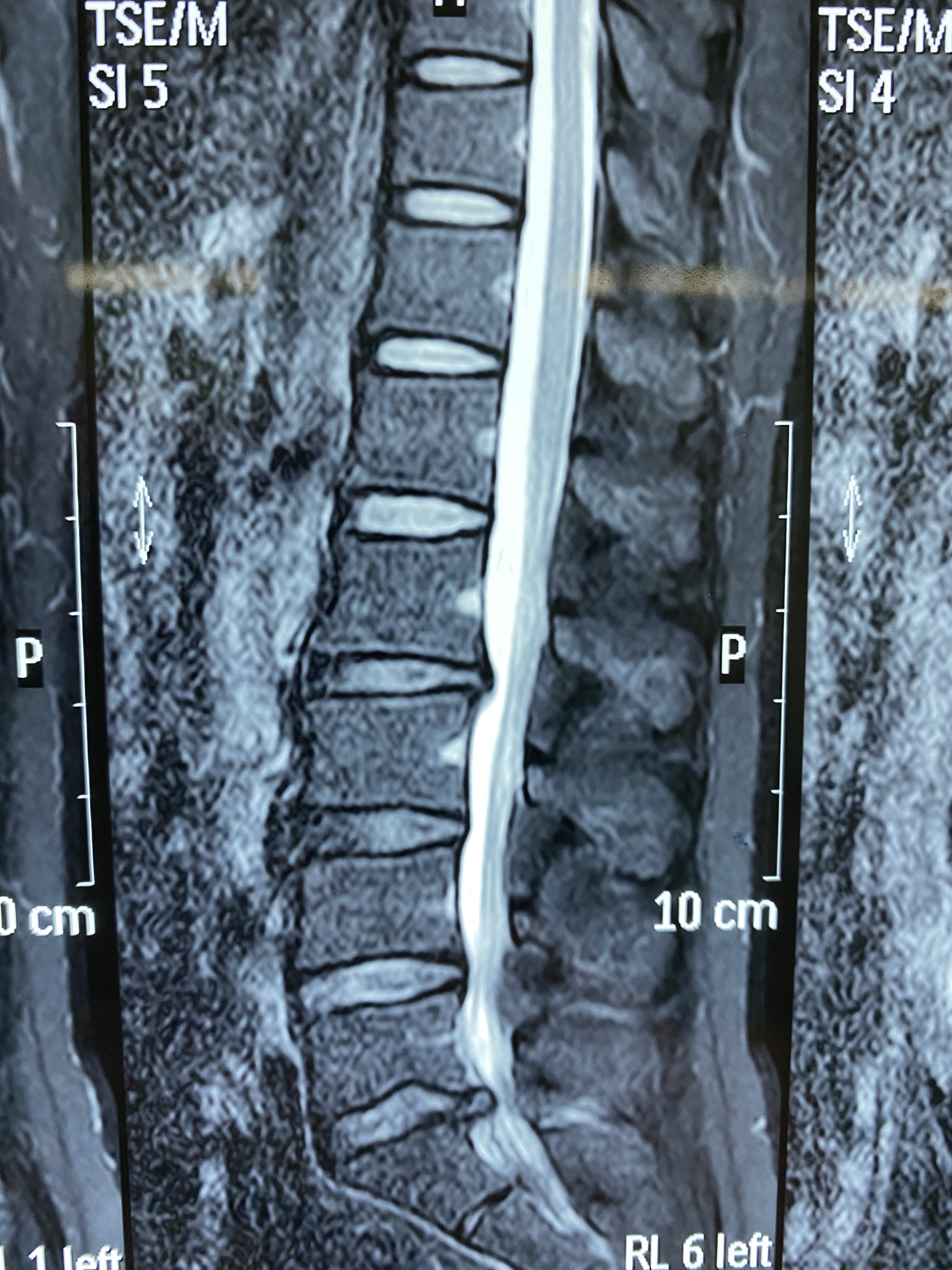 椎管狭窄的ct图片图片