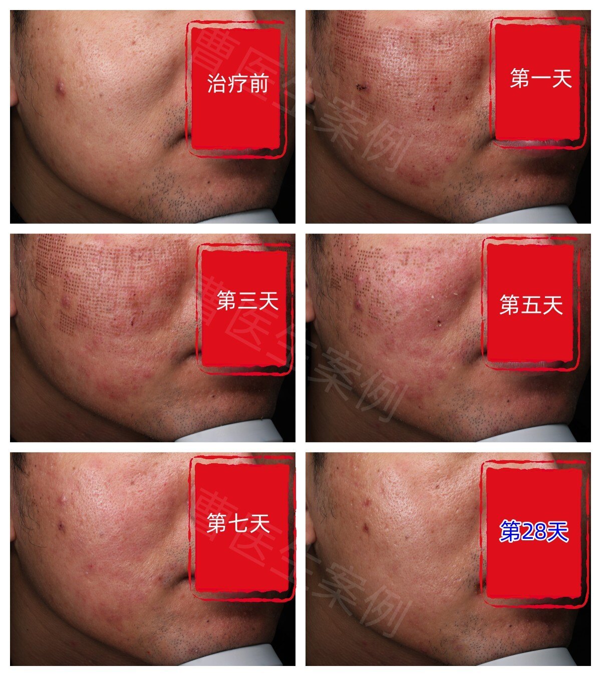 科医人超脉冲二氧化碳点阵激光治疗修复期_激光美容_激光美容治疗介绍